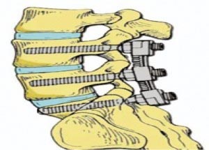 Minimally invasive (miss) spinal fusion definitions hospitalisation