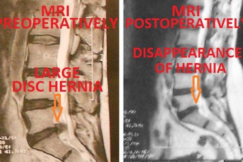transforaminal discoplasty