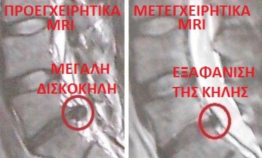 Μαγνητική Διατρηματική Δισκοπλαστική