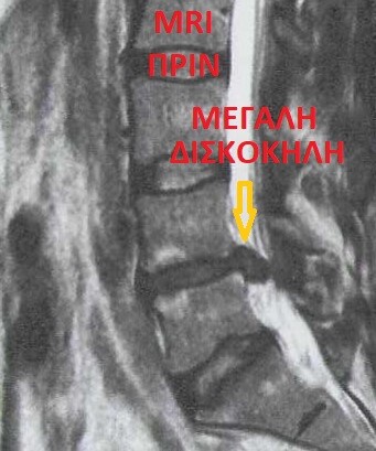 MRI πριν την επέμβαση