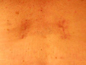Διαδερμική Σπονδυλοδεσία - τομές του δέρματος 