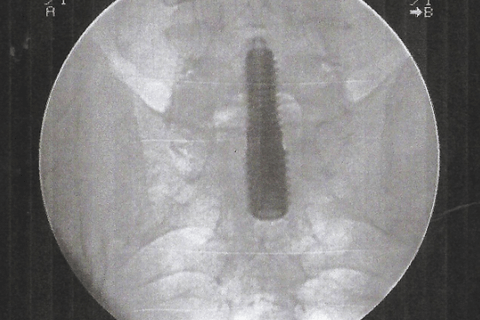 Εικόνα από το χειρουργείο..c-arm, τοποθέτηση κοχλία